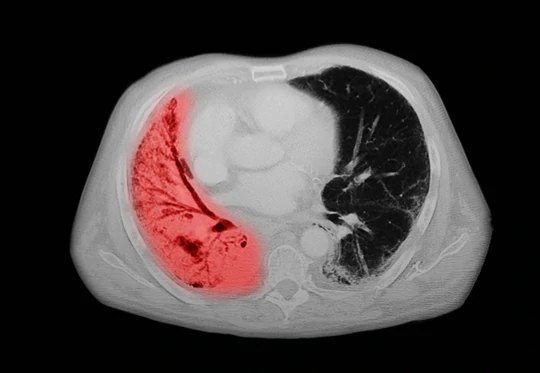 Aged Lung Cells Protected from Functional Decline with NMN